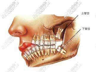 上智齿和下智齿位置示意图