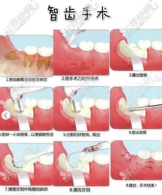 智齿手术过程