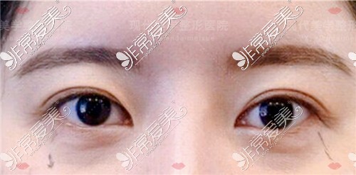 韩国现代美学整形外眼角修复+下至修复术前图
