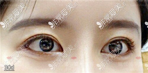 韩国现代美学整形外眼角修复+下至修复术后图
