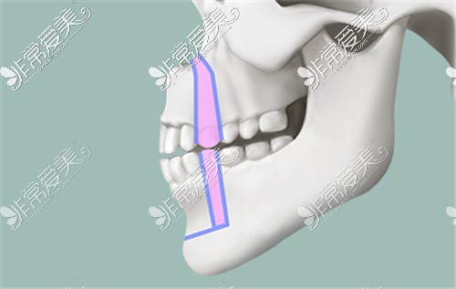 正颌手术动画图示