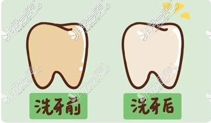 新疆吐鲁番刘海涛诊所洗牙示意图