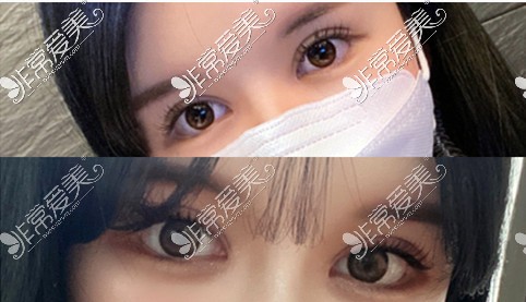韩国可来熙双眼皮修复术后一个月