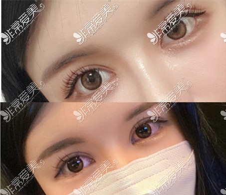 韩国可来熙双眼皮修复术后一个月