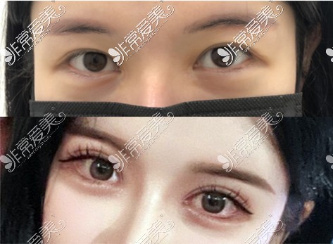 韩国可来熙双眼皮修复例子对比图