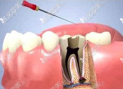 牙周治疗图片