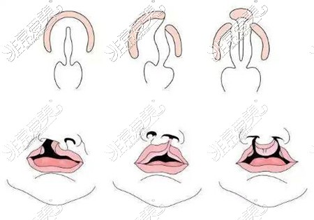 广州高尚医美整形医院可以做唇裂吗?修复优势特色有这几点!