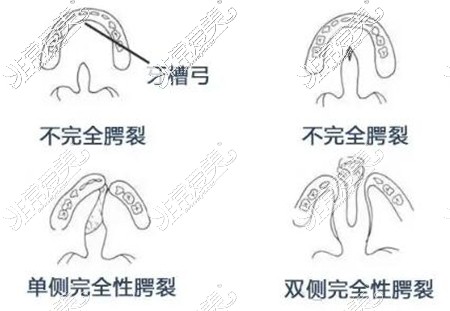 不同类型的唇裂修复改善