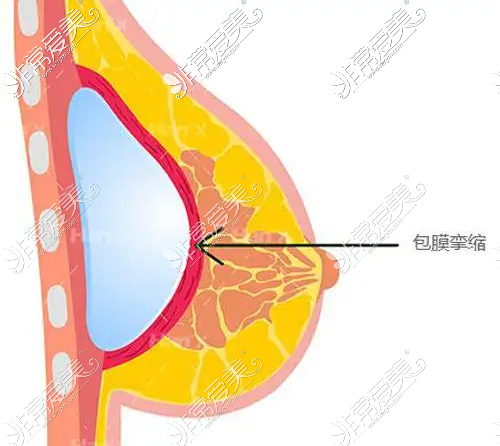 包膜攣縮示意圖