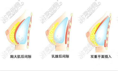 隆胸示意圖