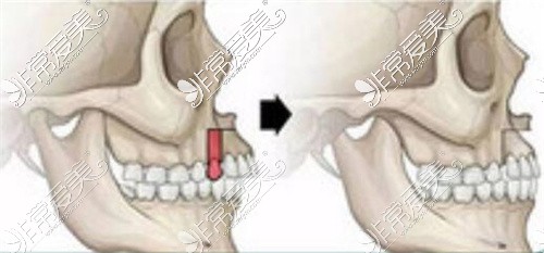 上颌骨截骨手术过程解析,看后秒懂上颌骨矫正手术是怎么做