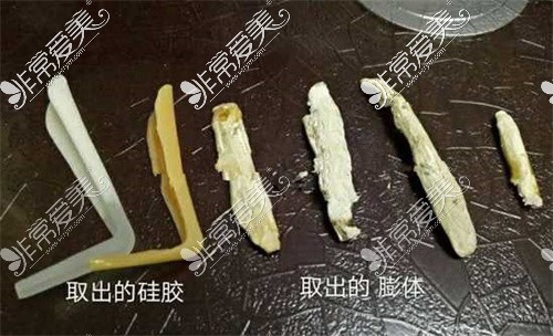 鼻部假体取出图