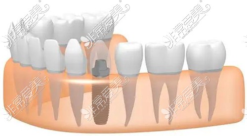 种植牙示意图