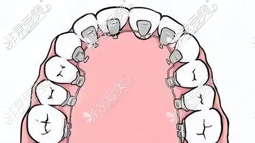 舌側(cè)矯正示意圖