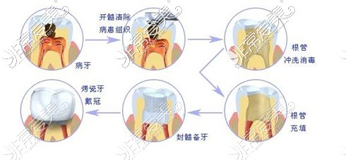 新疆哈密小杨口腔根管治疗示意图