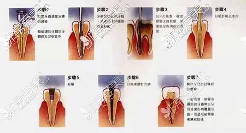 经验谈:重庆根管治疗多少钱一颗牙加牙冠?可以社保报销吗?