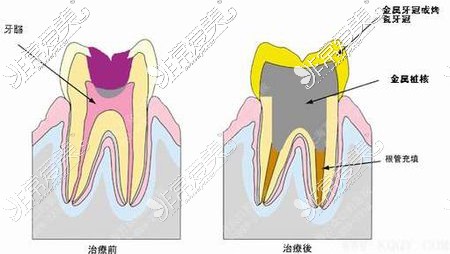 根管治療前后對比漫畫圖