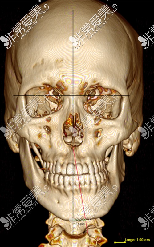 偏颌CT图