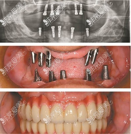 全口种植术前术后图