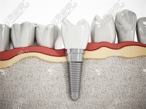 新疆喀什柏赛佳口腔种植牙示意图