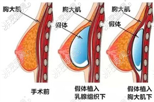 假體隆胸術(shù)法示意圖