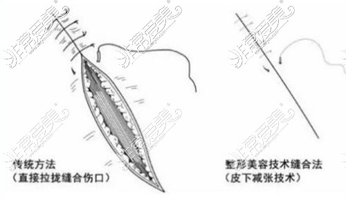 隆胸疤痕缝合示意图