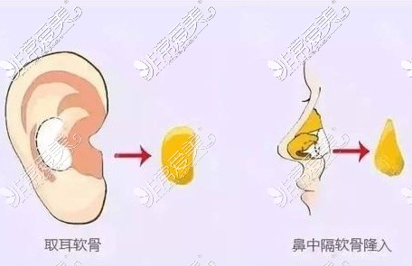 耳软骨隆鼻手术示意图