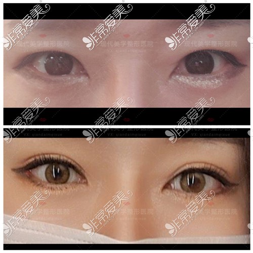 韩国现代美学整形医院做双眼皮修复+提肌+内眼角+外眼角+下至整形对比