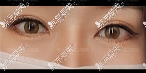 韩国现代美学整形医院做双眼皮修复+提肌+内眼角+外眼角+下至术后