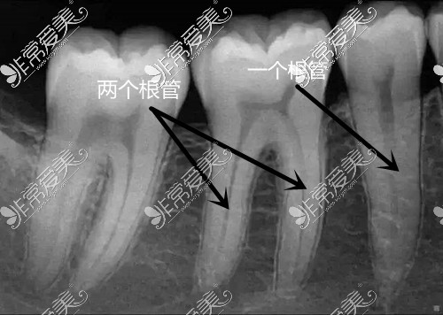 岳阳根管治疗多少钱一颗牙