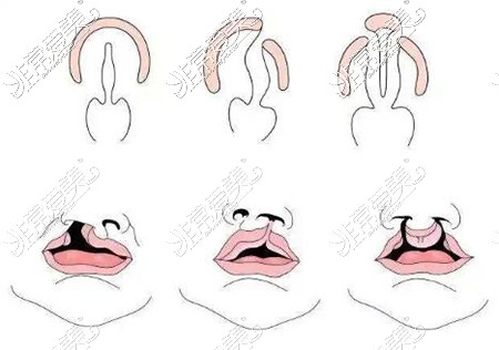 唇裂修复改善治疗展示图