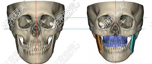 颌面整形CT图