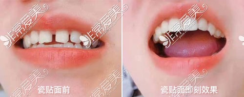 武漢壹加壹口腔醫(yī)院瓷貼面前后對比照片