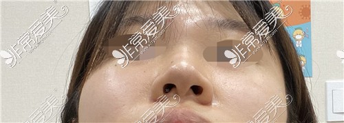 韩国KOKO整形医院鼻综合术前