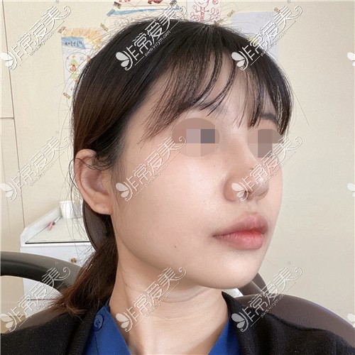 韩国KOKO整形医院鼻综合术后图