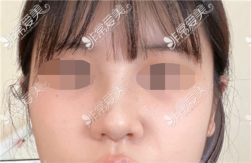 韩国KOKO整形医院鼻综合术后正面图