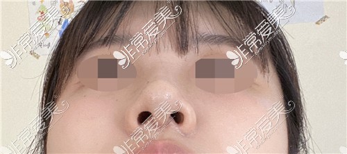 韩国KOKO整形医院鼻综合术后图示