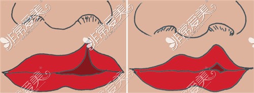 很多唇裂修復(fù)完并不理想