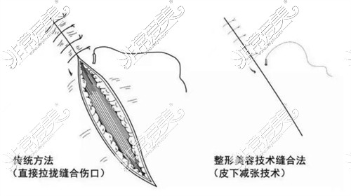 美杜莎双眼皮缝合示意图