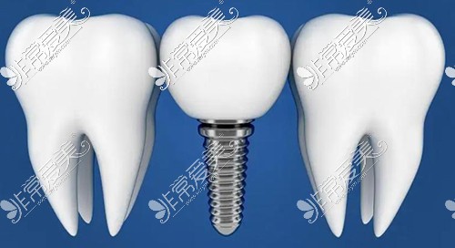 延边种植牙多少钱一颗？详细分析延边种植牙价格！