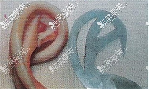 人工耳朵支架