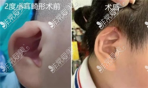耳朵畸形手术对比