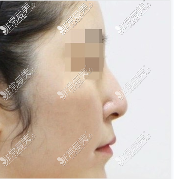 鼻子整形术前图