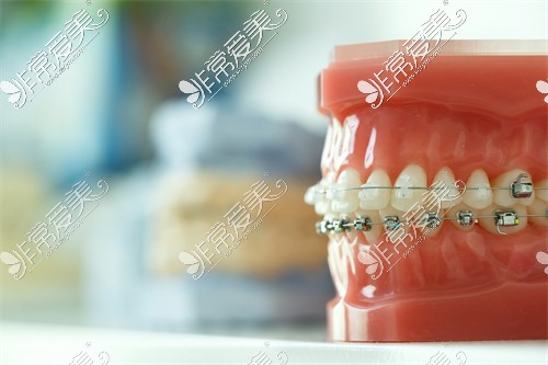 牙齿矫正模型展示