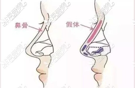 新疆王共礼整形鼻修复示意图