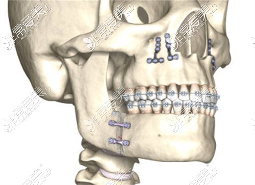 正颌手术示意图