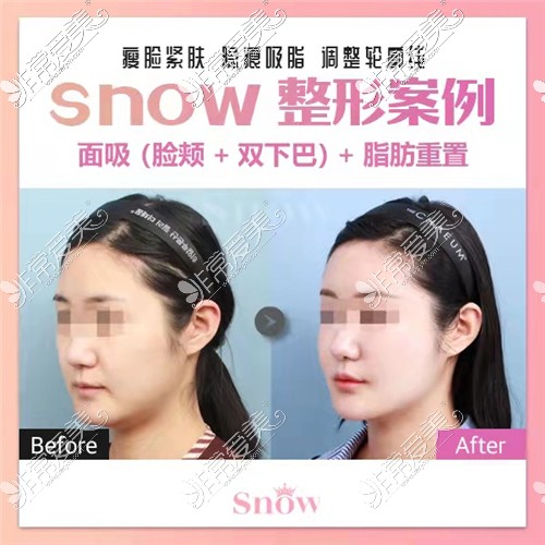 韩国Snow整形面吸+脂肪填充前后图