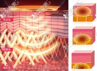 热拉提改善治疗优势