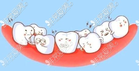 牙齿拥挤改善治疗