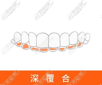 深覆合牙齒矯正改善